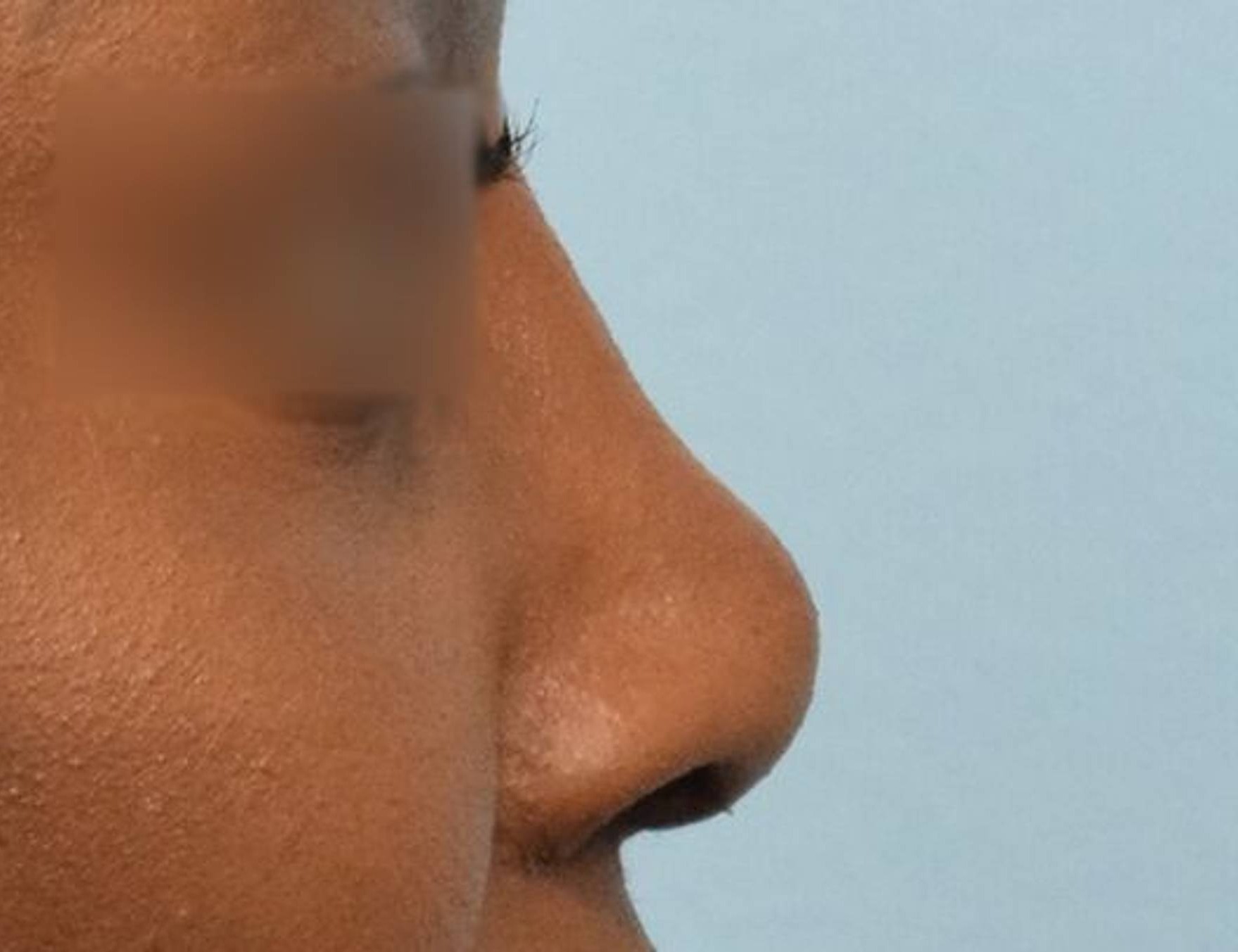 Rhinoplasty Before & After Image