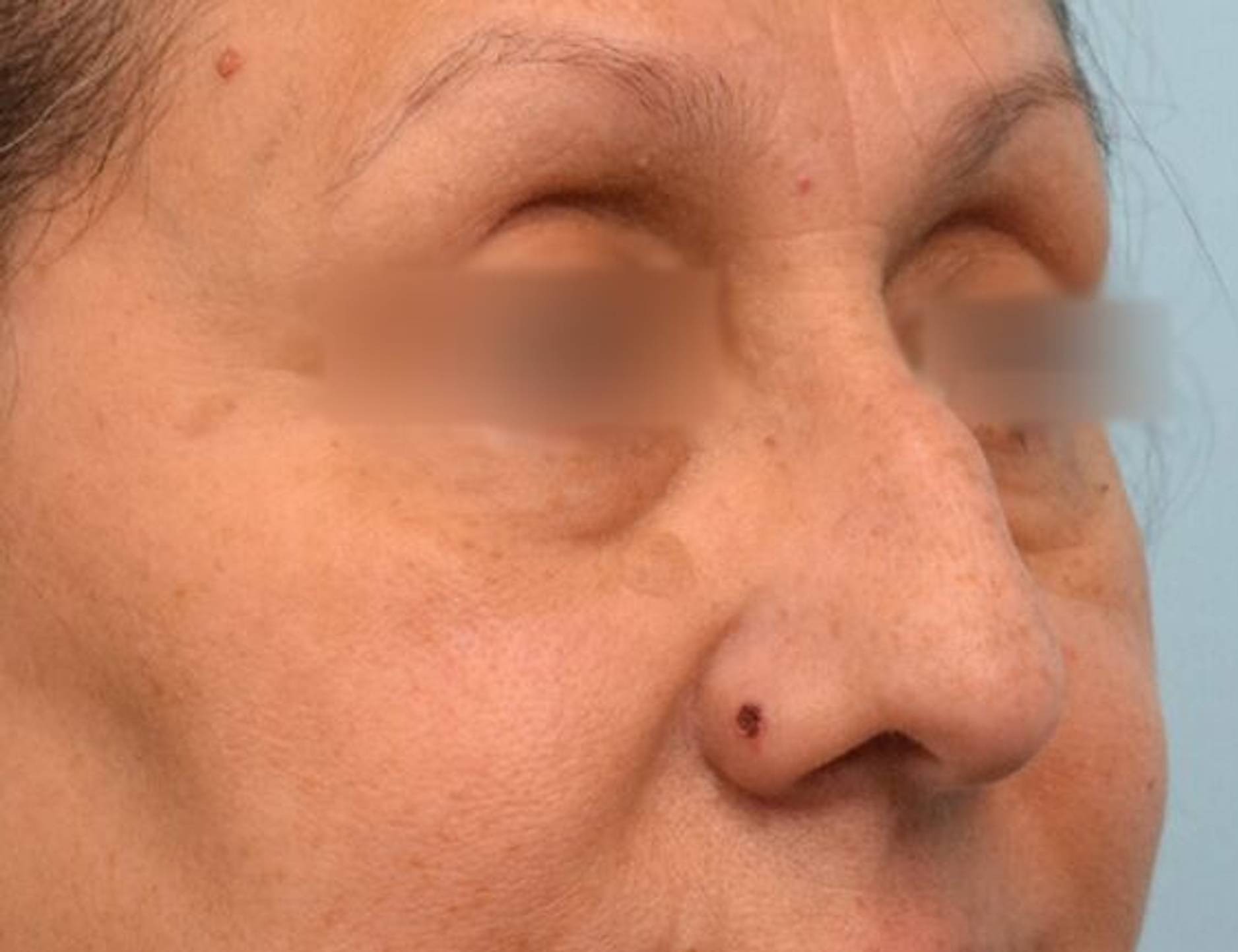 Rhinoplasty Before & After Image