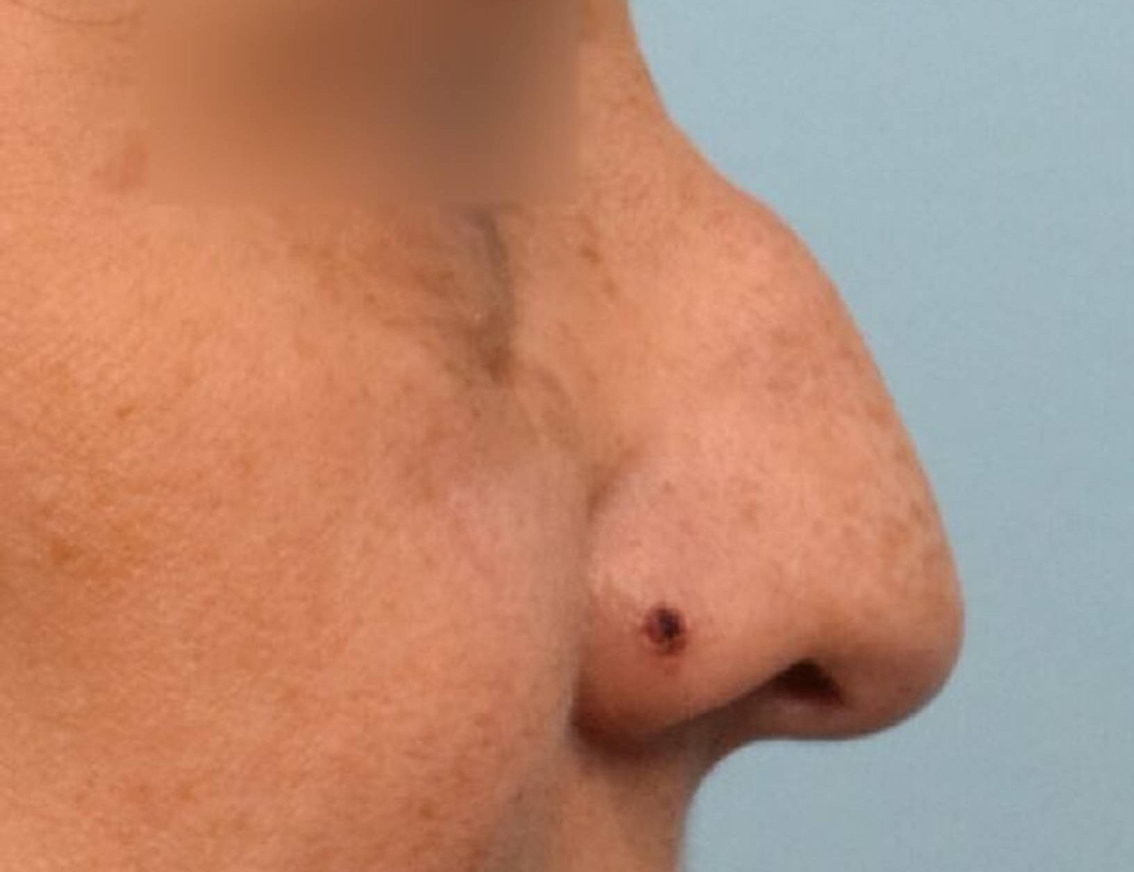 Rhinoplasty Before & After Image