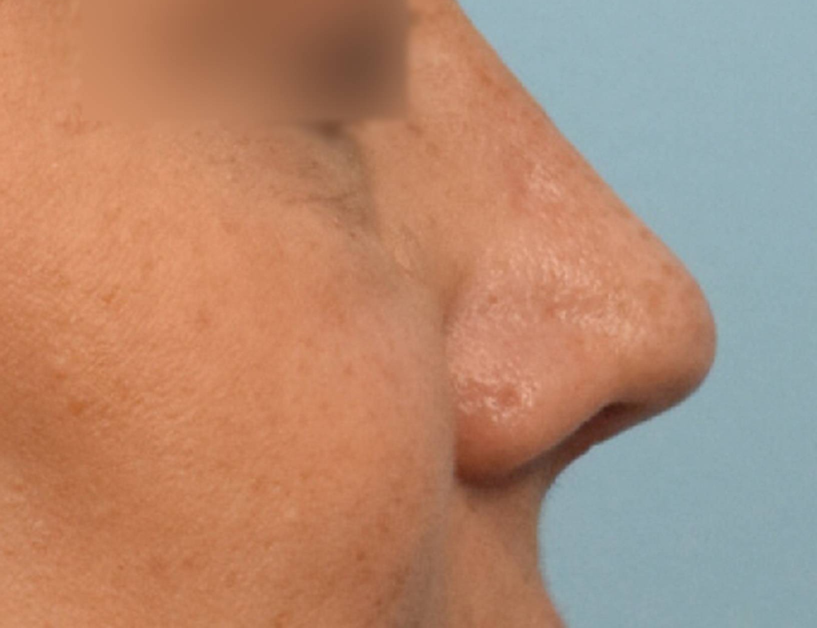 Rhinoplasty Before & After Image