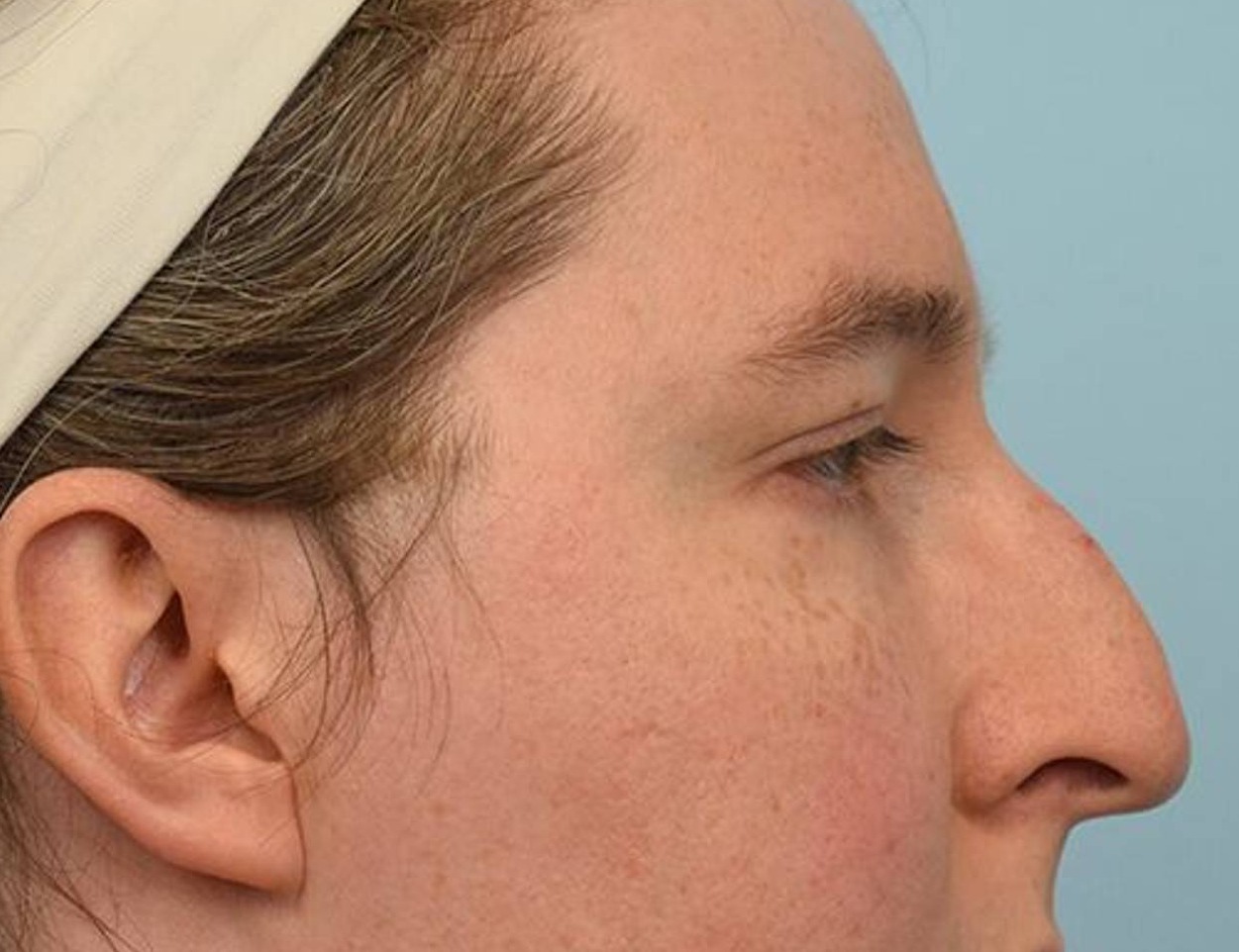 Rhinoplasty Before & After Image