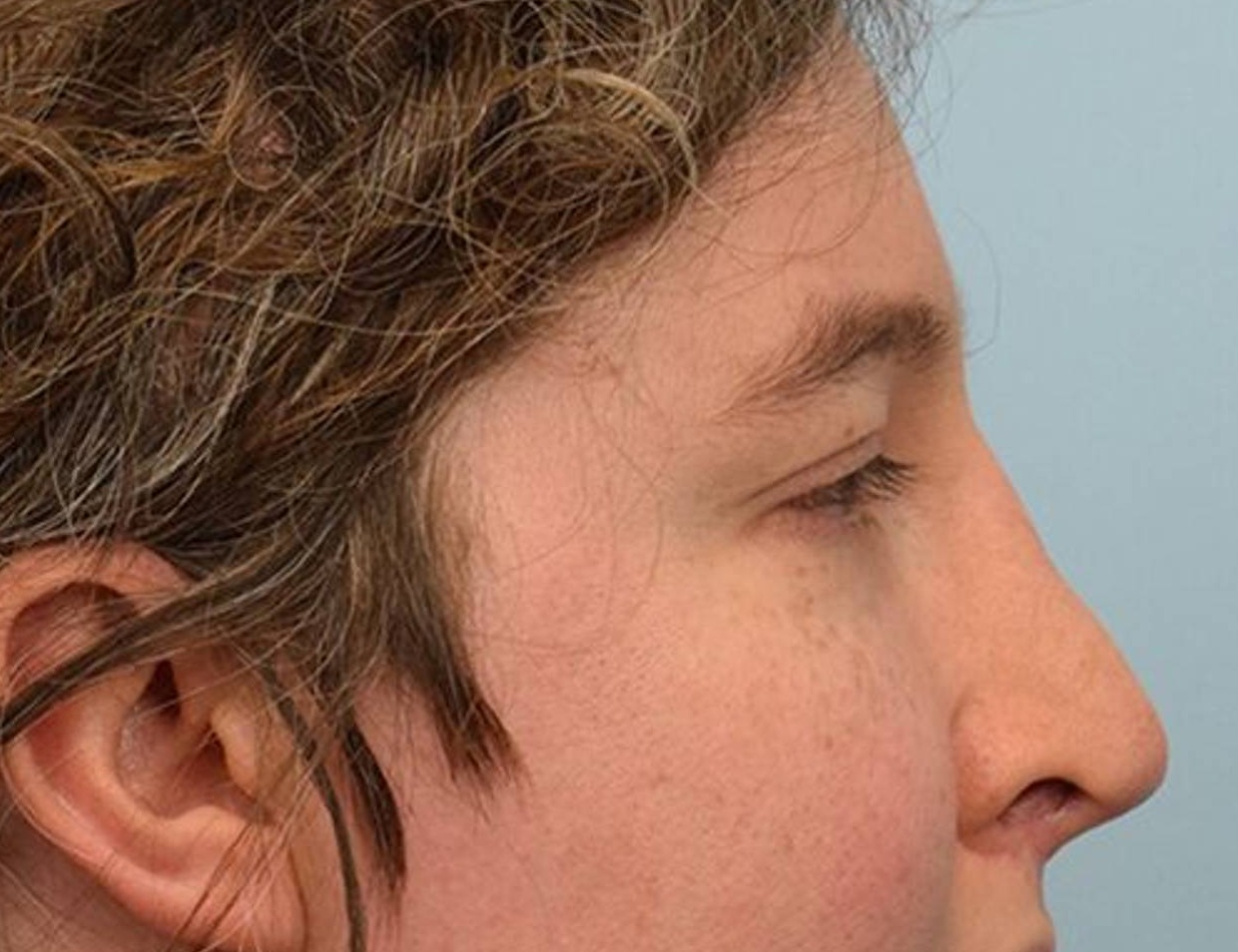 Rhinoplasty Before & After Image