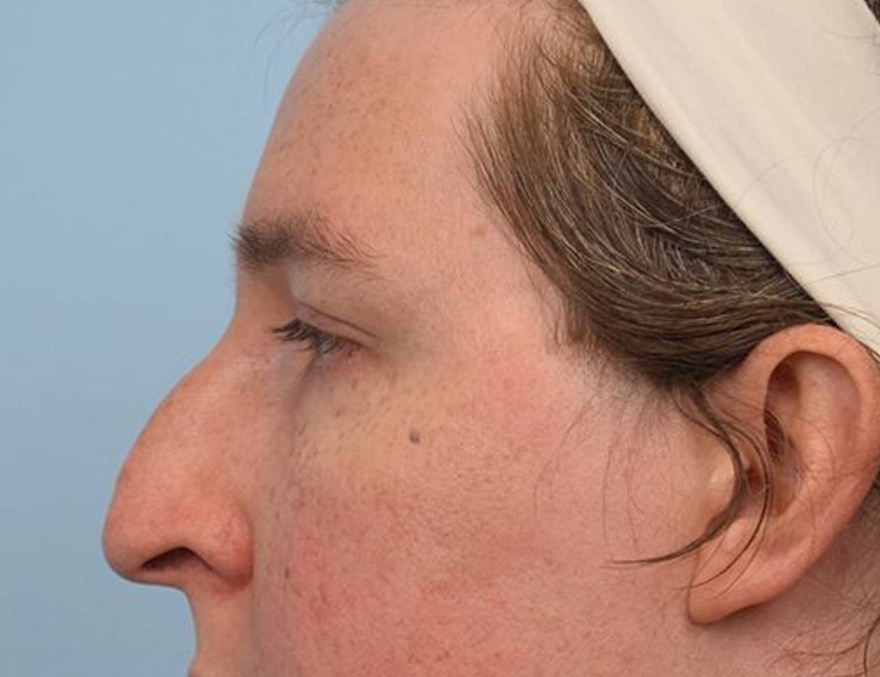 Rhinoplasty Before & After Image