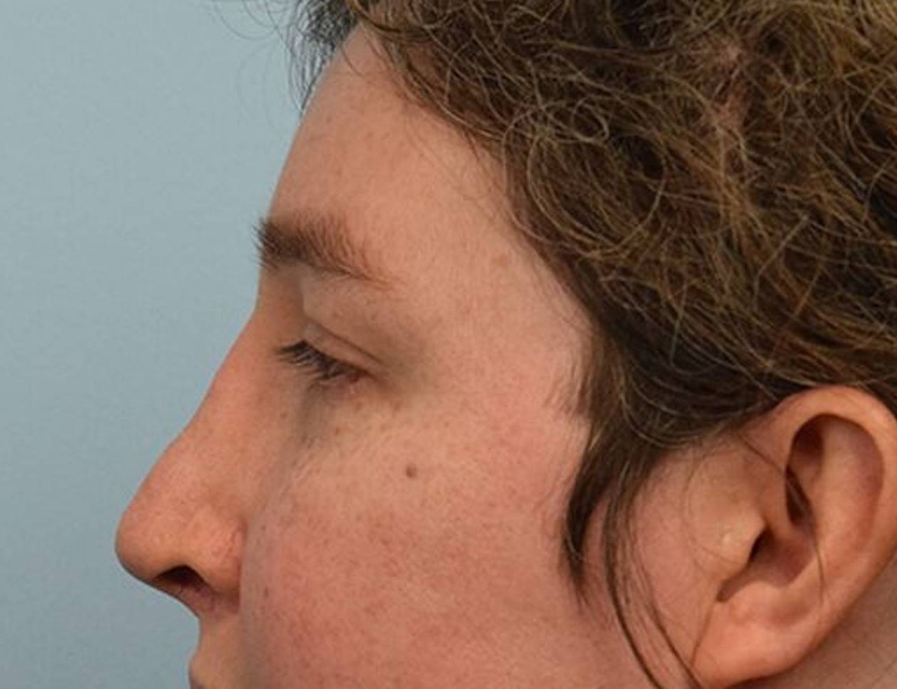 Rhinoplasty Before & After Image