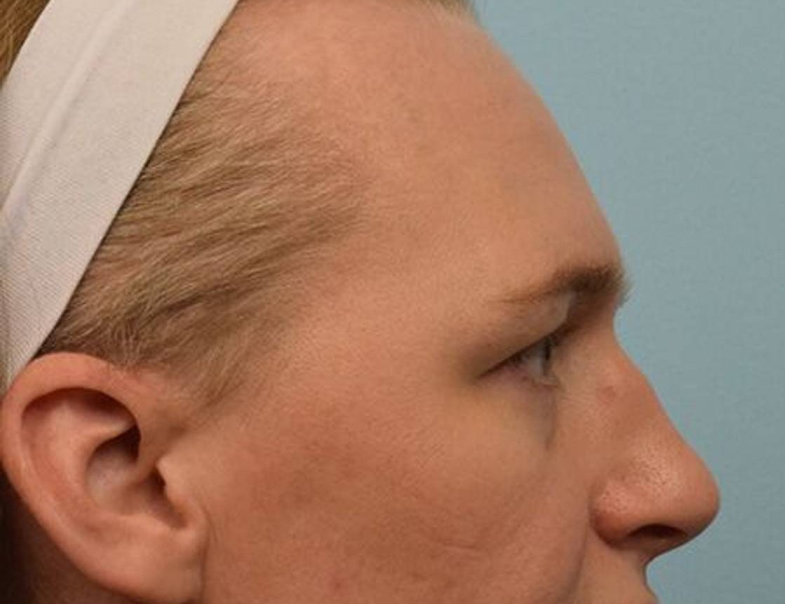 Rhinoplasty Before & After Image