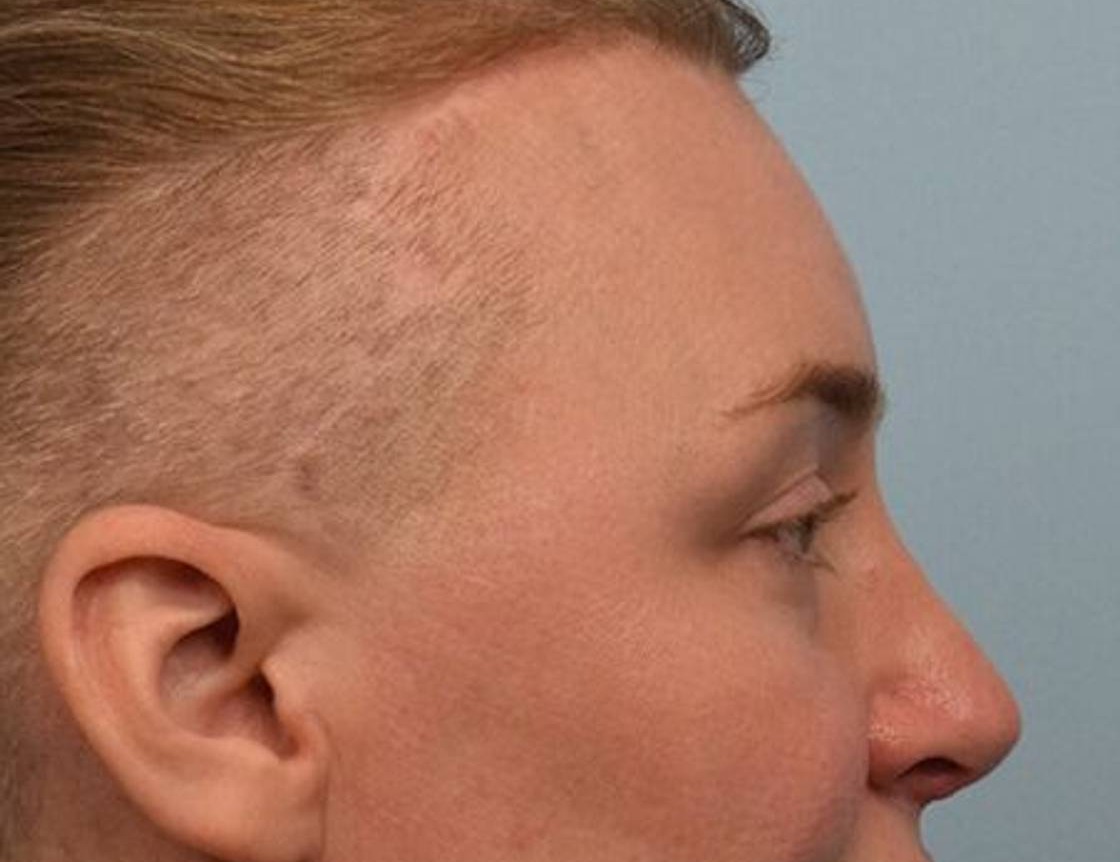 Rhinoplasty Before & After Image