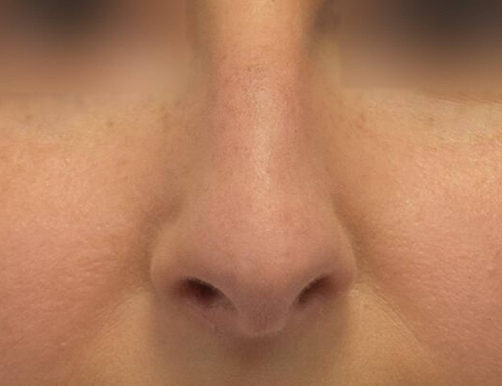 Rhinoplasty Before & After Image