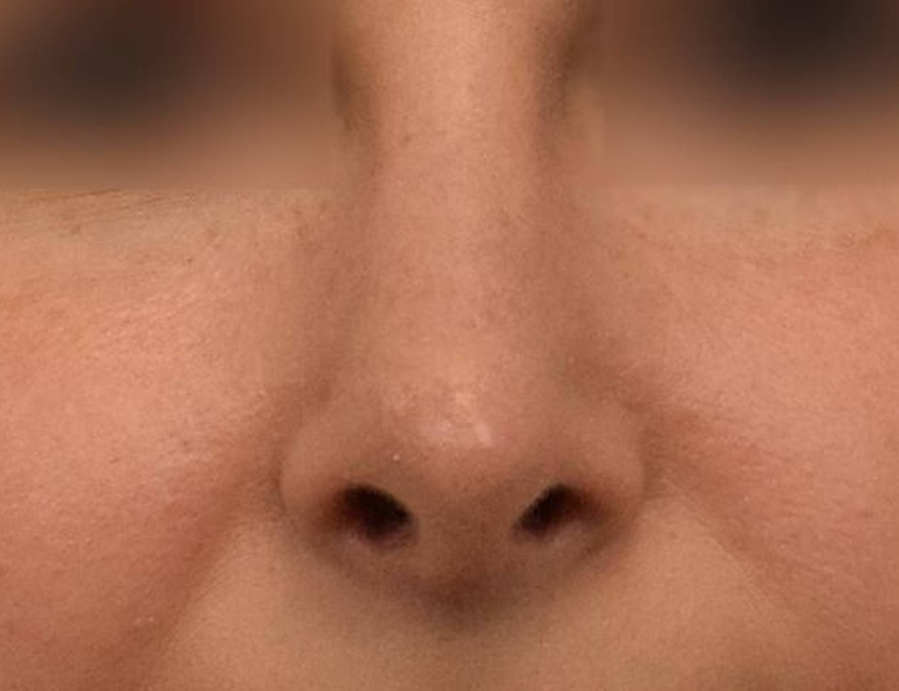 Rhinoplasty Before & After Image