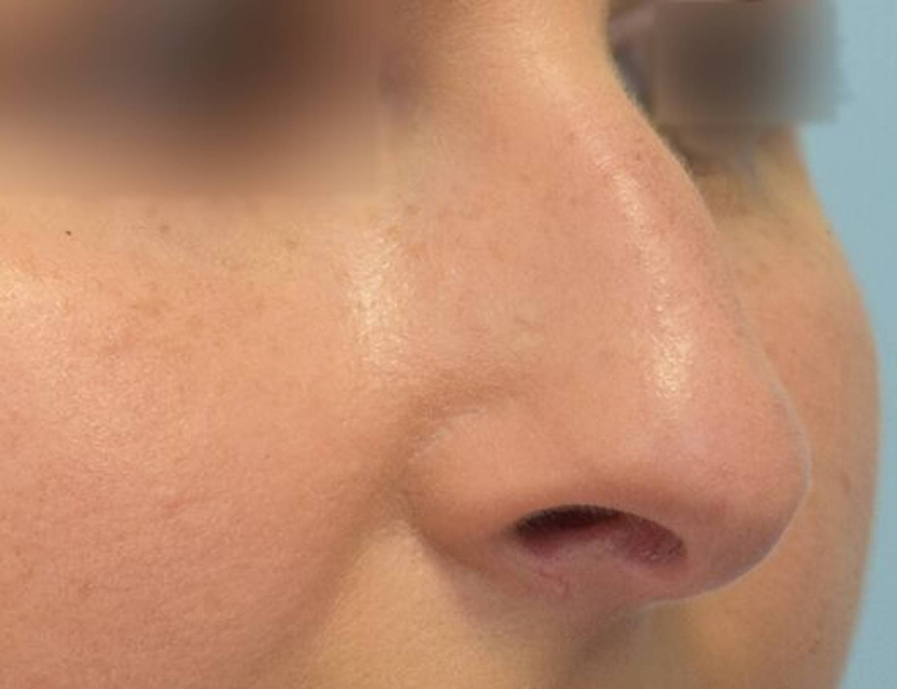 Rhinoplasty Before & After Image