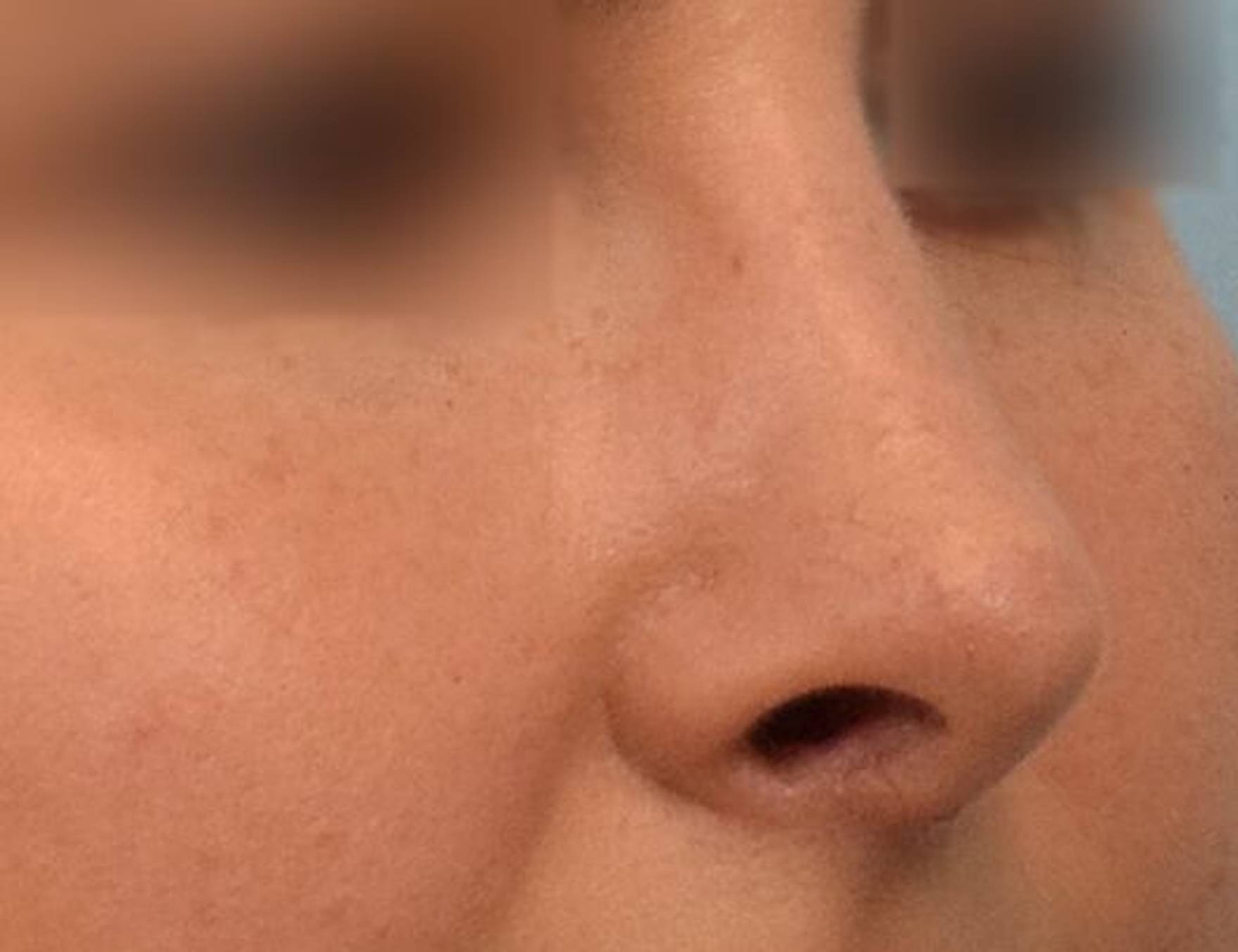 Rhinoplasty Before & After Image