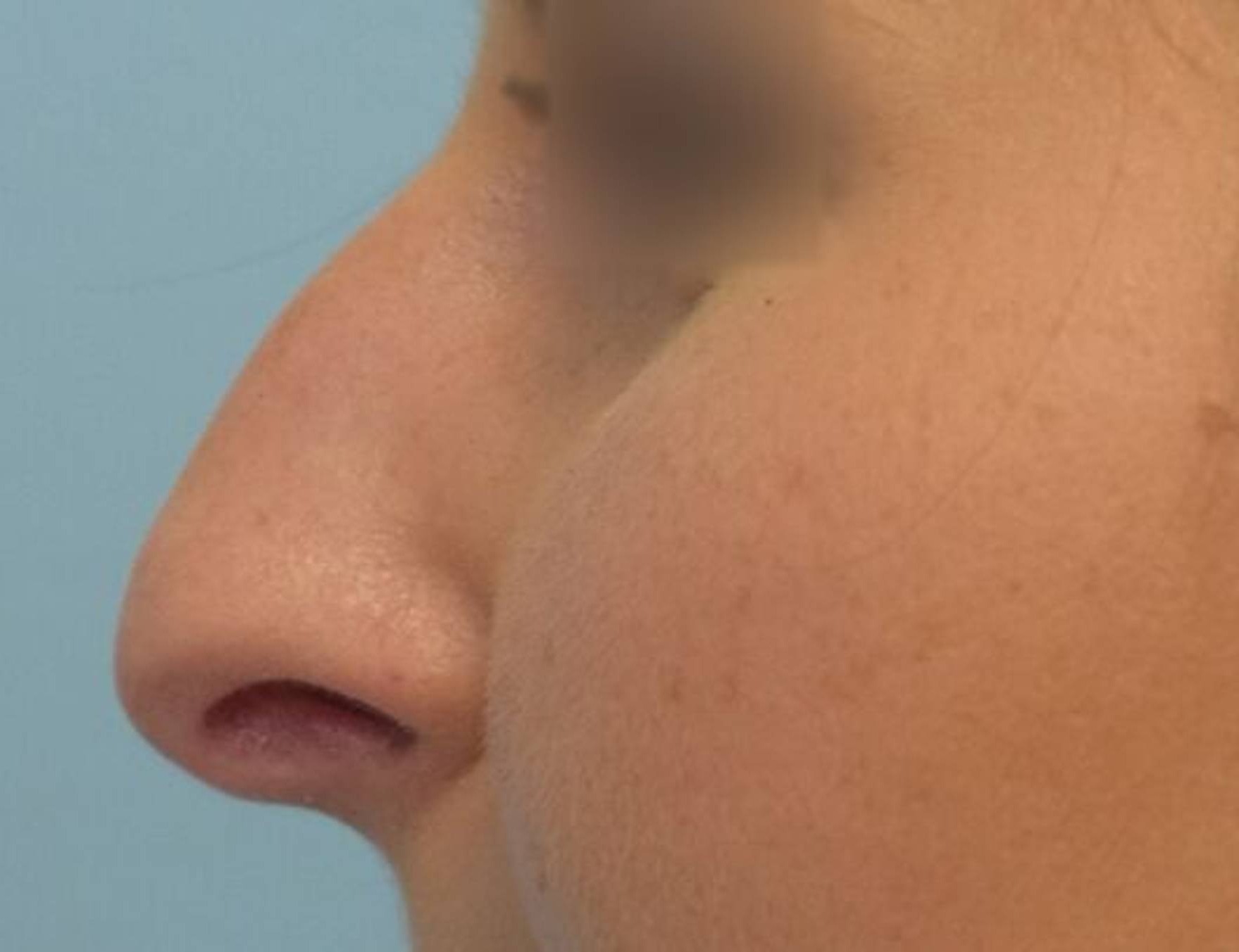 Rhinoplasty Before & After Image