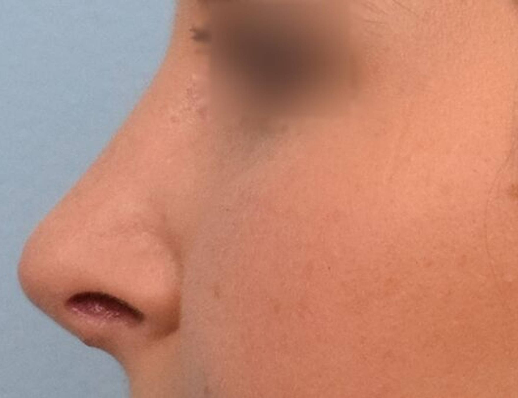 Rhinoplasty Before & After Image