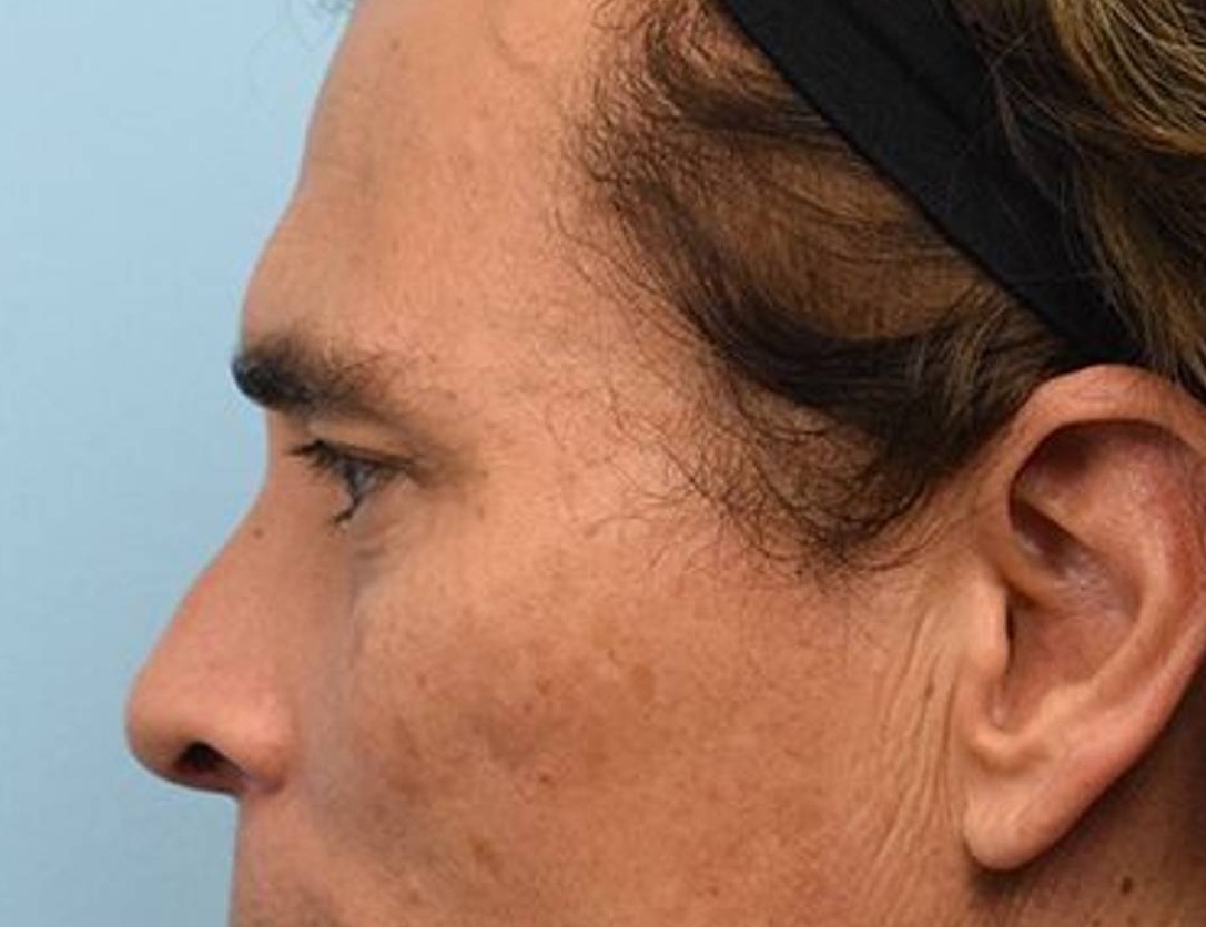 Rhinoplasty Before & After Image