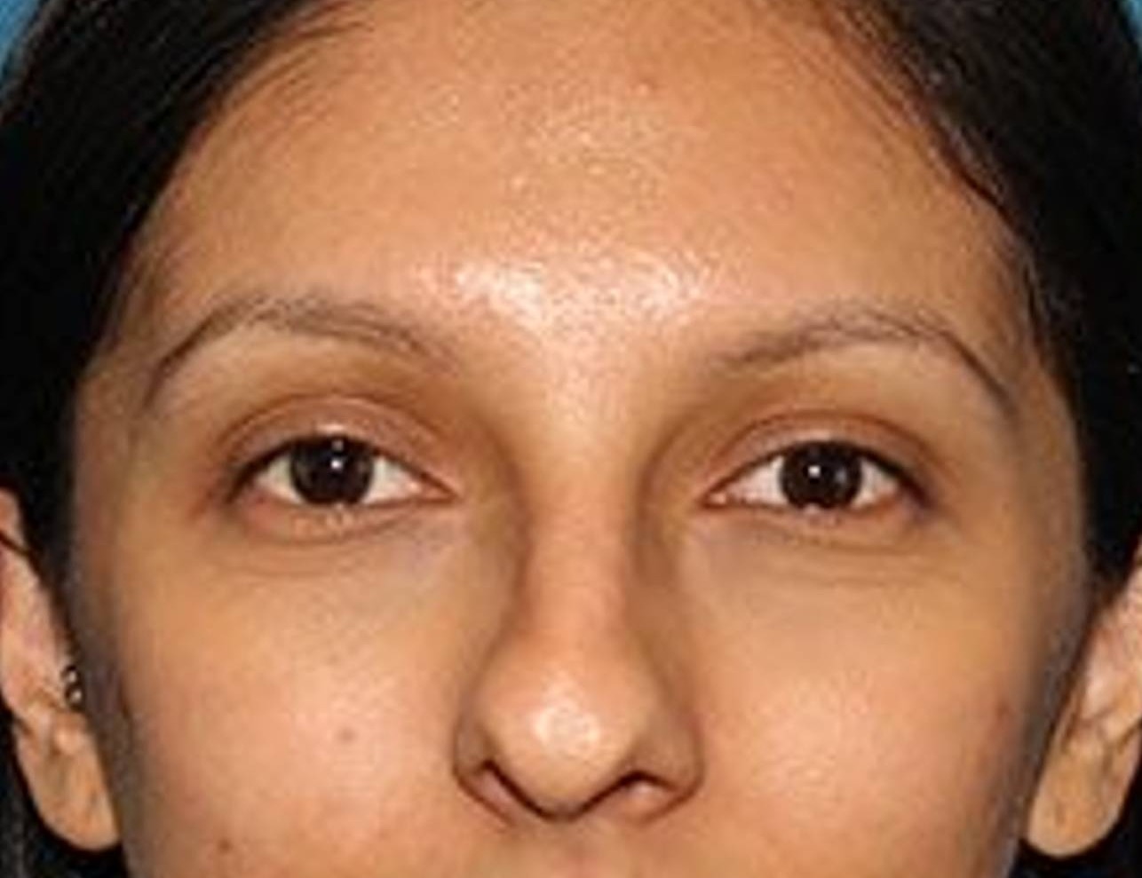 Rhinoplasty Before & After Image