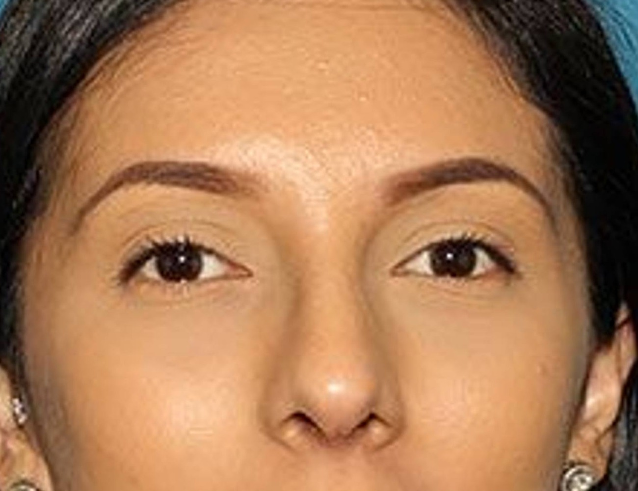 Rhinoplasty Before & After Image