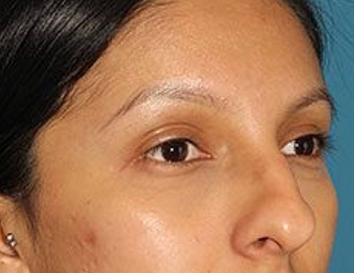 Rhinoplasty Before & After Image