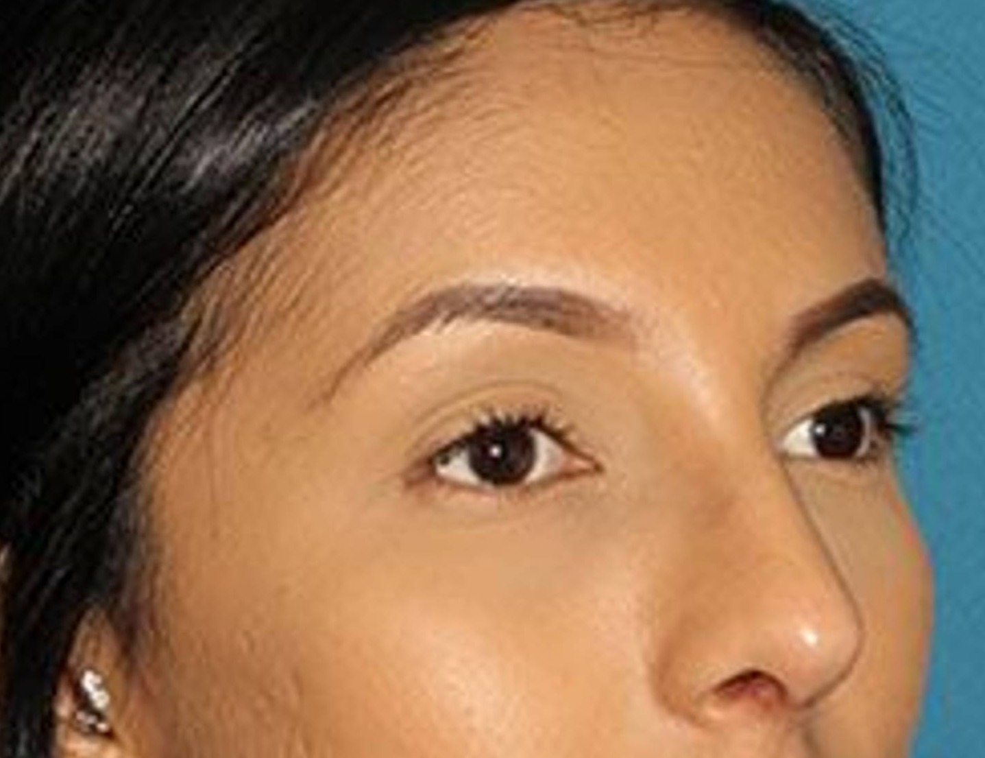 Rhinoplasty Before & After Image