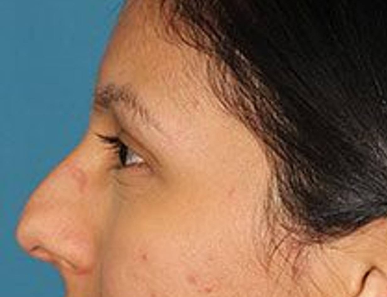 Rhinoplasty Before & After Image