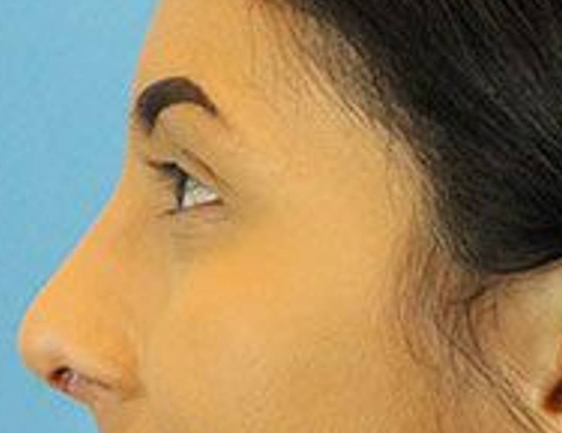 Rhinoplasty Before & After Image