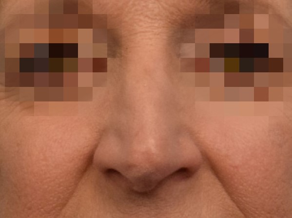 Rhinoplasty Before & After Image