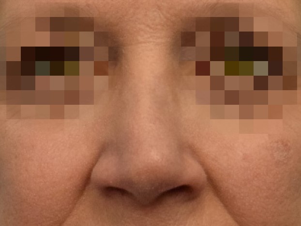 Rhinoplasty Before & After Image