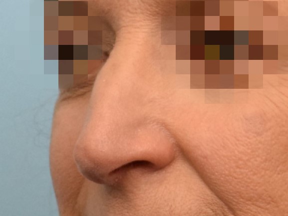 Rhinoplasty Before & After Image