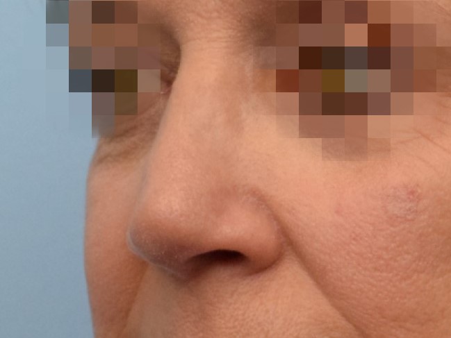 Rhinoplasty Before & After Image