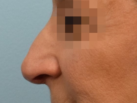 Rhinoplasty Before & After Image