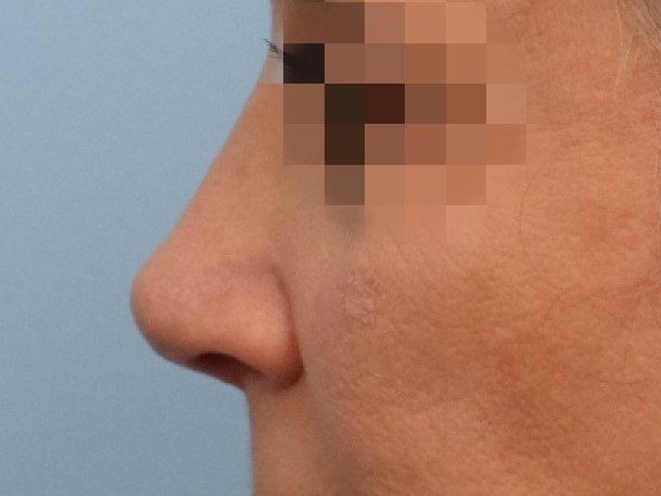 Rhinoplasty Before & After Image