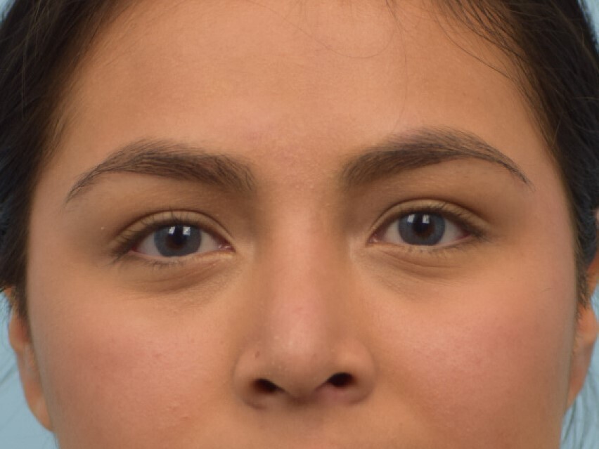 Rhinoplasty Before & After Image