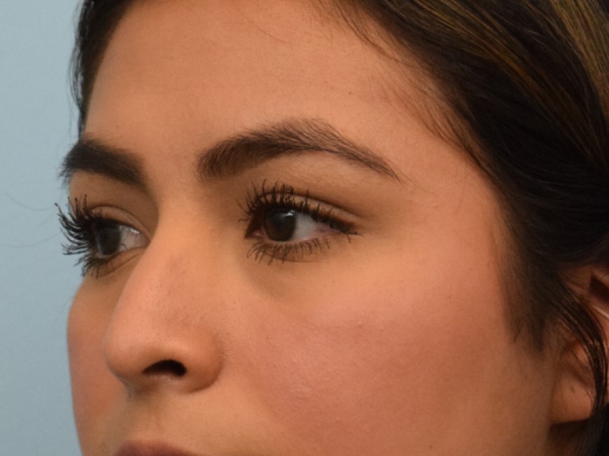 Rhinoplasty Before & After Image