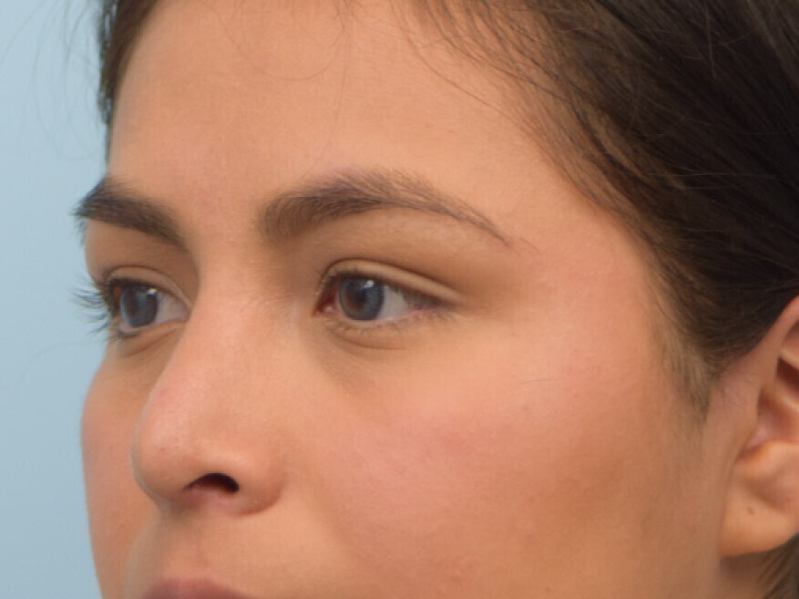 Rhinoplasty Before & After Image