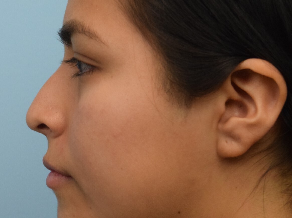 Rhinoplasty Before & After Image