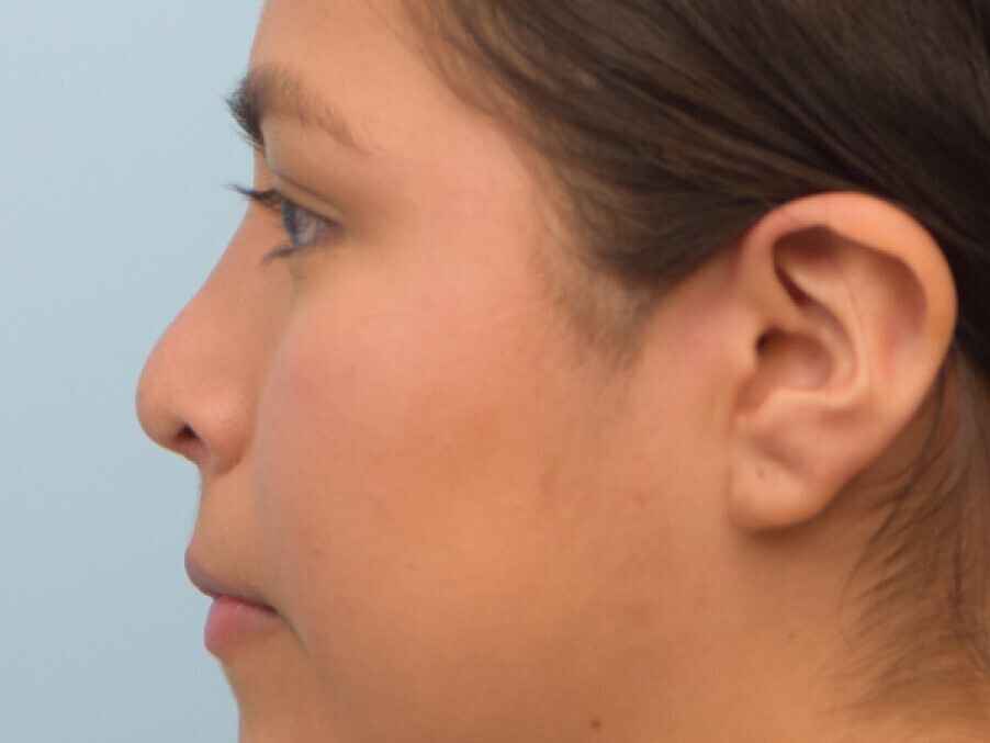 Rhinoplasty Before & After Image