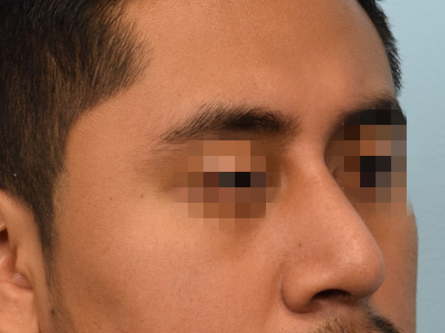 Rhinoplasty Before & After Image