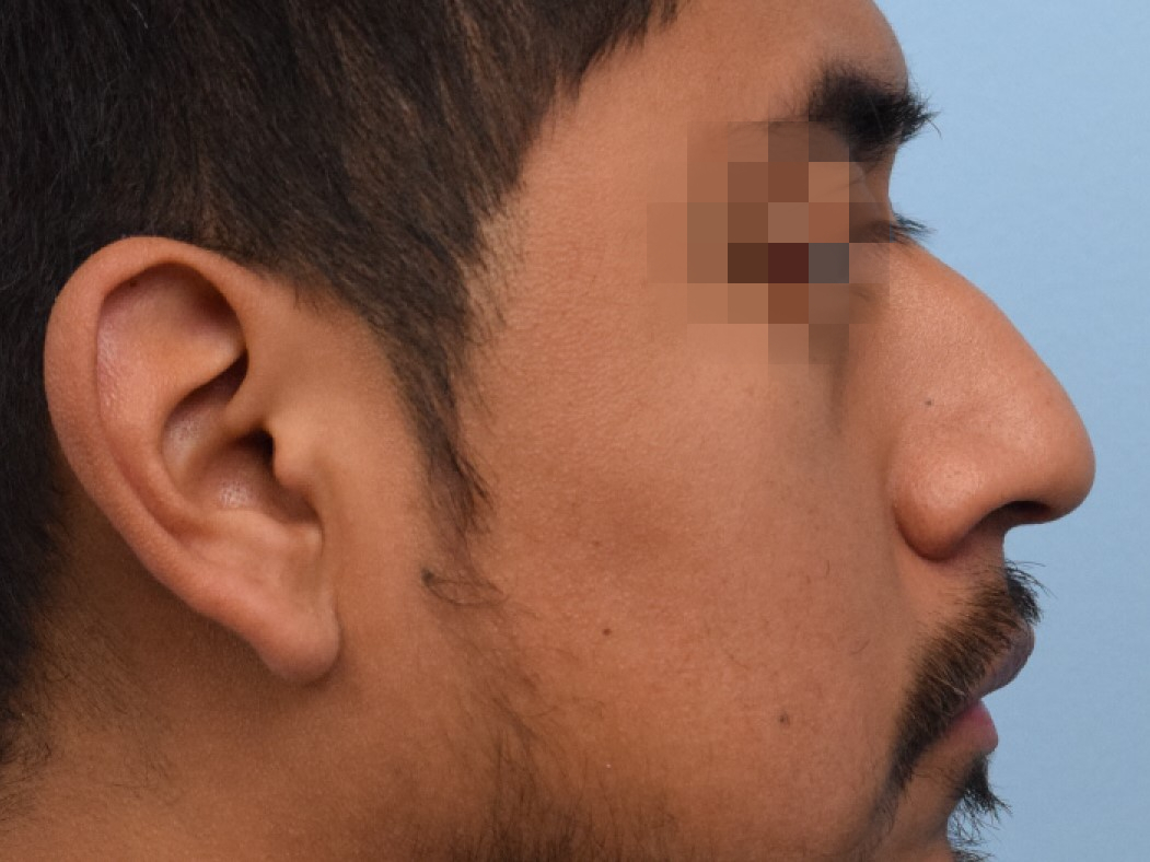 Rhinoplasty Before & After Image