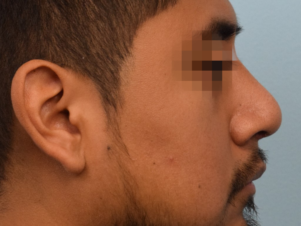 Rhinoplasty Before & After Image