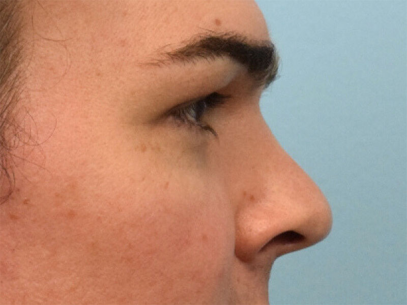 Rhinoplasty Before & After Image