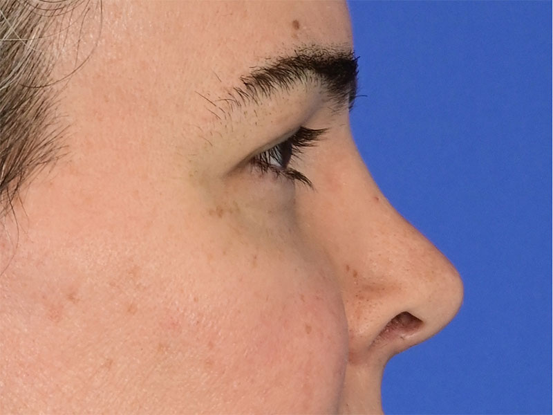 Rhinoplasty Before & After Image