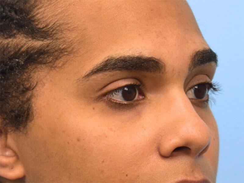 Rhinoplasty Before & After Image