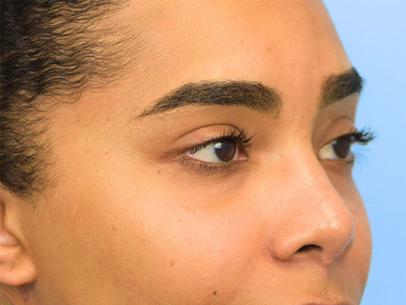 Rhinoplasty Before & After Image