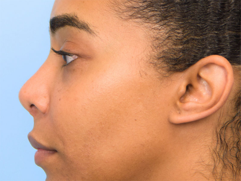 Rhinoplasty Before & After Image