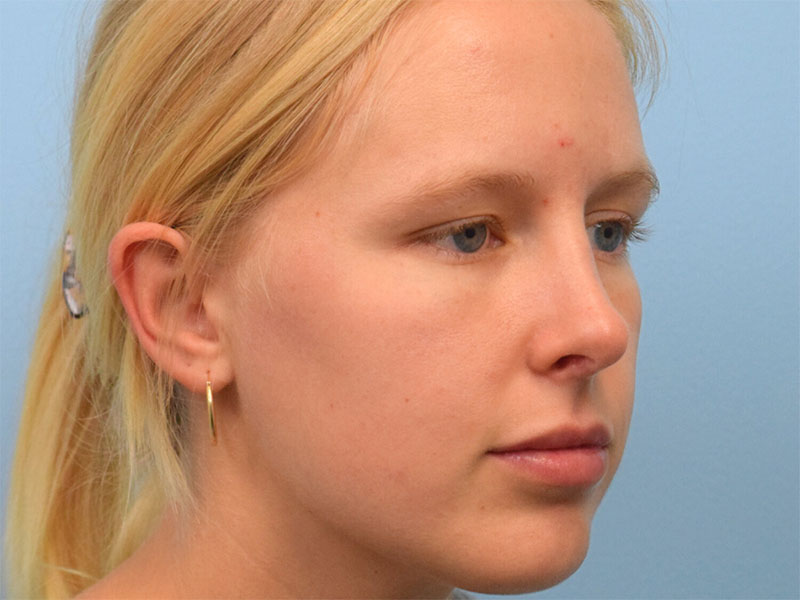 Rhinoplasty Before & After Image