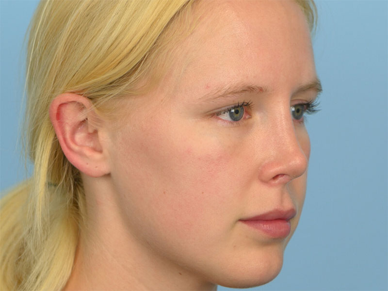 Rhinoplasty Before & After Image