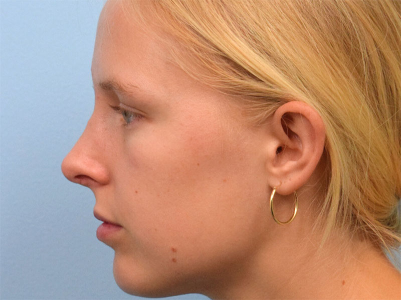 Rhinoplasty Before & After Image