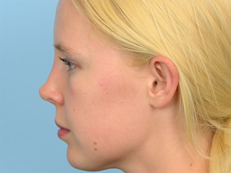 Rhinoplasty Before & After Image