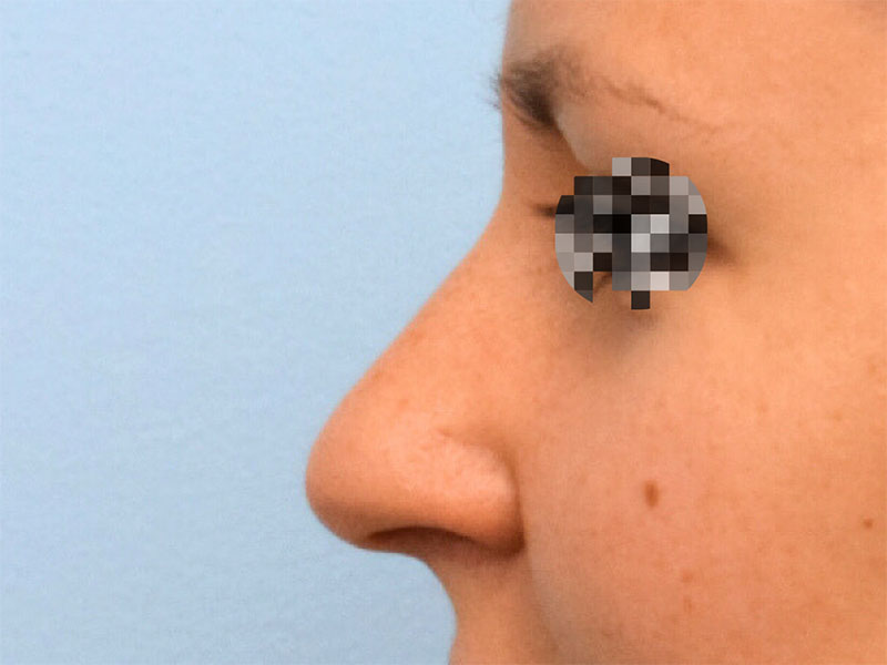 Rhinoplasty Before & After Image