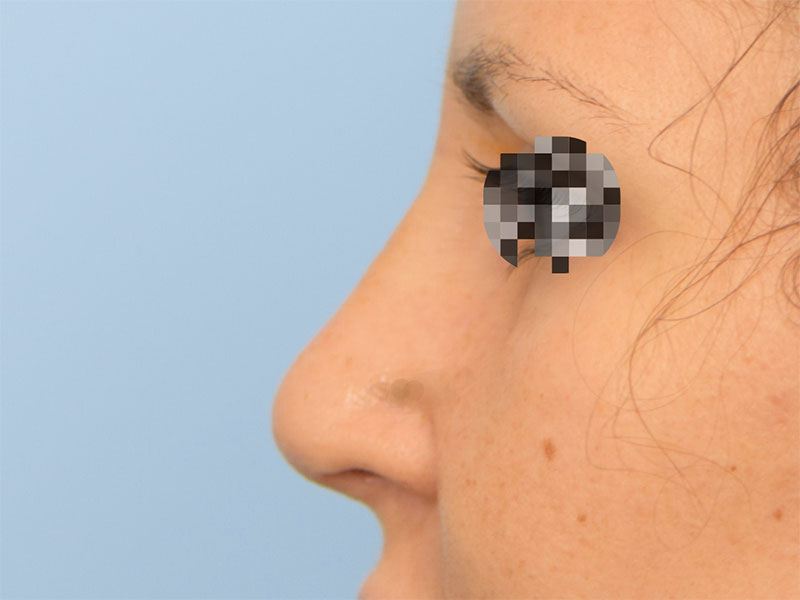 Rhinoplasty Before & After Image