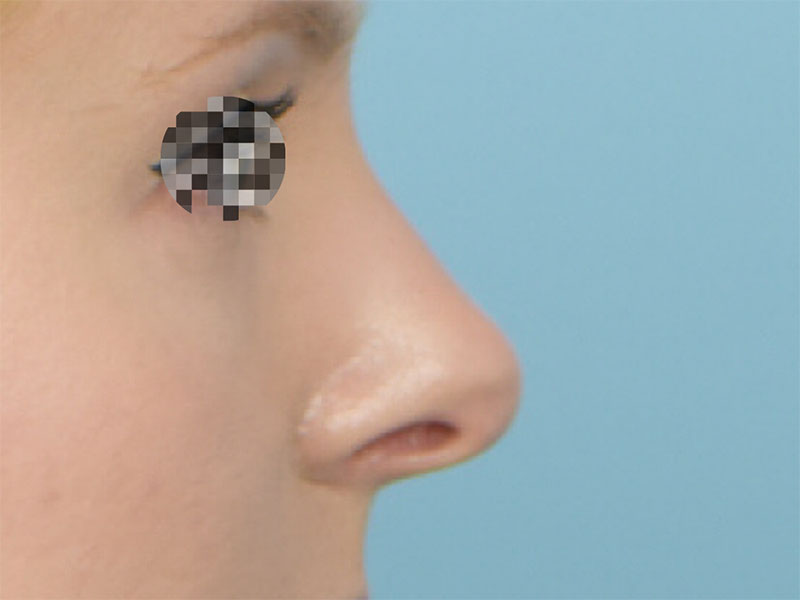 Rhinoplasty Before & After Image