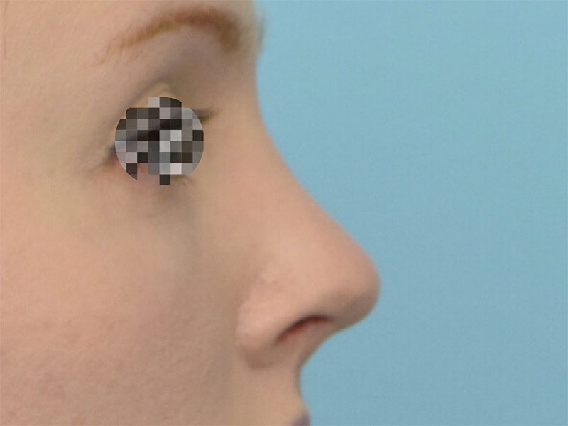 Rhinoplasty Before & After Image